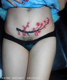 剖腹产 梅花.png